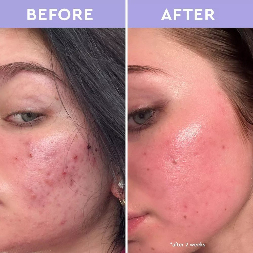 Spot A Spot Exfoliating Blemish Solution